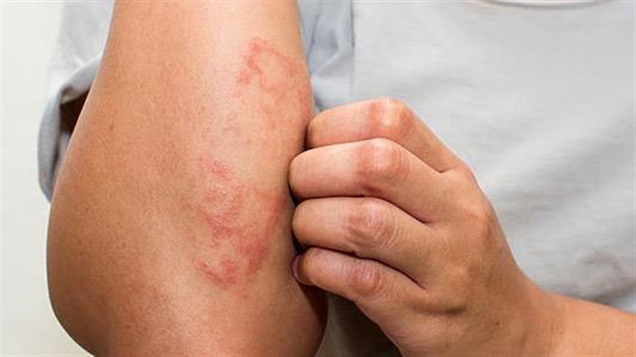 Έκζεμα ή ξηροδερμία; – Δείτε πώς θα τα ξεχωρίσετε και πώς θα τα αντιμετωπίσετε