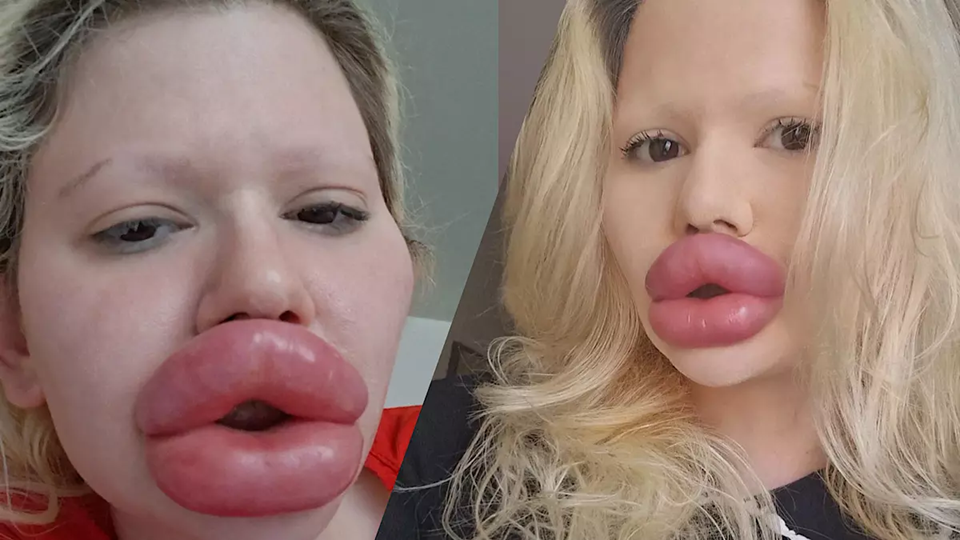 Andrea Ivanova: Η 28χρονη με τα μεγαλύτερα χείλη στον κόσμο που οι γιατροί αρνιούνται να την αναλάβουν πια (φώτο)