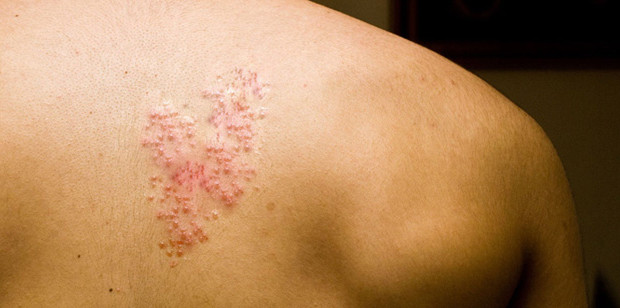 Έρπης ζωστήρος: Αυτές είναι οι τροφές που πρέπει να αποφεύγετε – Ποιες μπορούν να βελτιώσουν την έξαρση