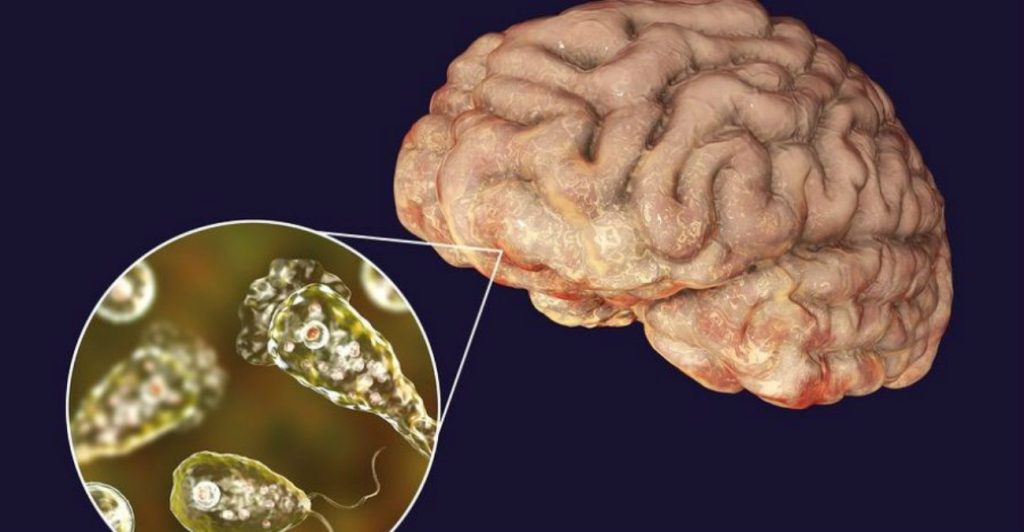 ΗΠΑ: Νεκρός 12χρονος από αμοιβάδα που τρώει τον εγκέφαλο – Ποια τα πρώιμα συμπτώματα