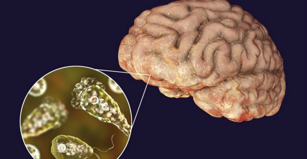 ΗΠΑ: Νεκρός 12χρονος από αμοιβάδα που τρώει τον εγκέφαλο – Ποια τα πρώιμα συμπτώματα