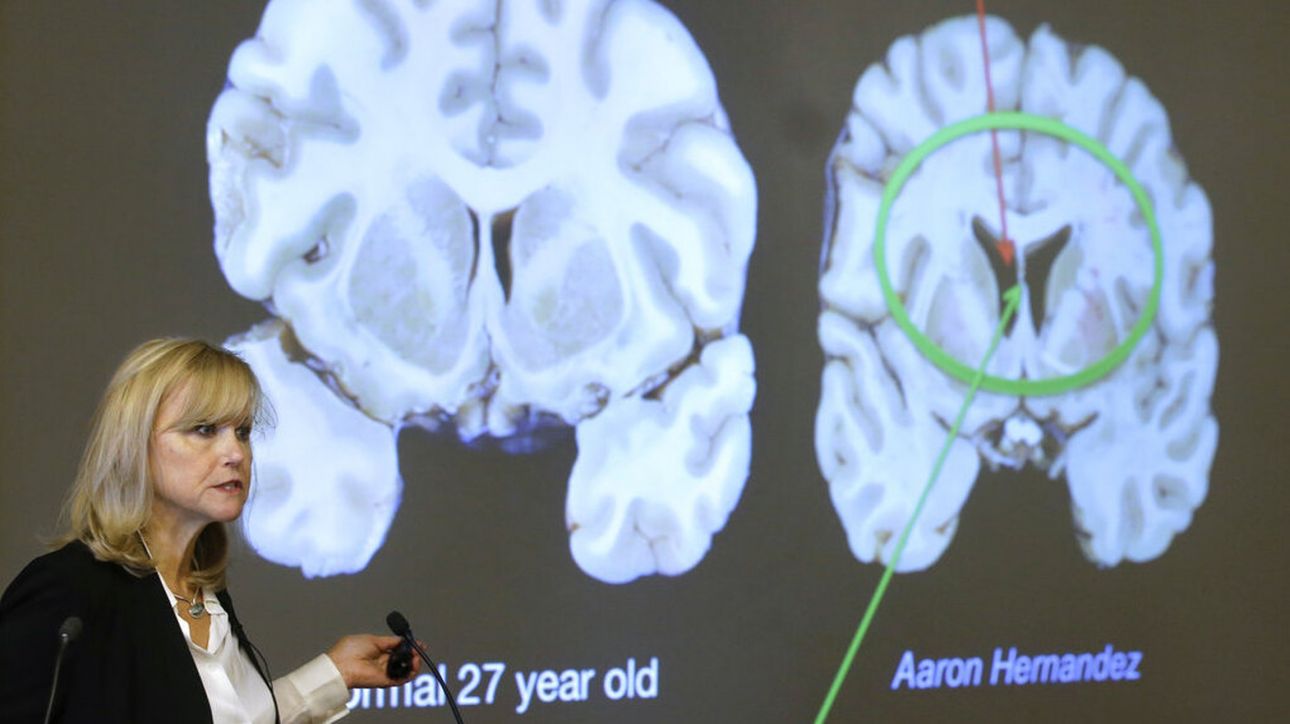 Χρόνια τραυματική εγκεφαλοπάθεια: Τα αίτια εμφάνισης της πάθησης του δράστη της ένοπλης επίθεσης στο Μανχάταν