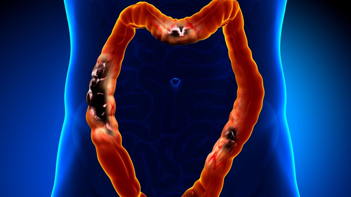 Ογκολόγος αποκαλύπτει: Αυτές είναι οι κοινές συνήθειες που ευνοούν τον καρκίνο του παχέος εντέρου πριν τα 40