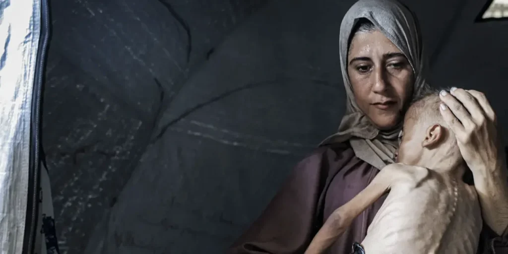 NΥΤ: Διόρθωσαν την ιστορία πίσω από τη φωτογραφία με το αποστεωμένο παιδί στη Γάζα – «Έπασχε και από άλλη πάθηση»