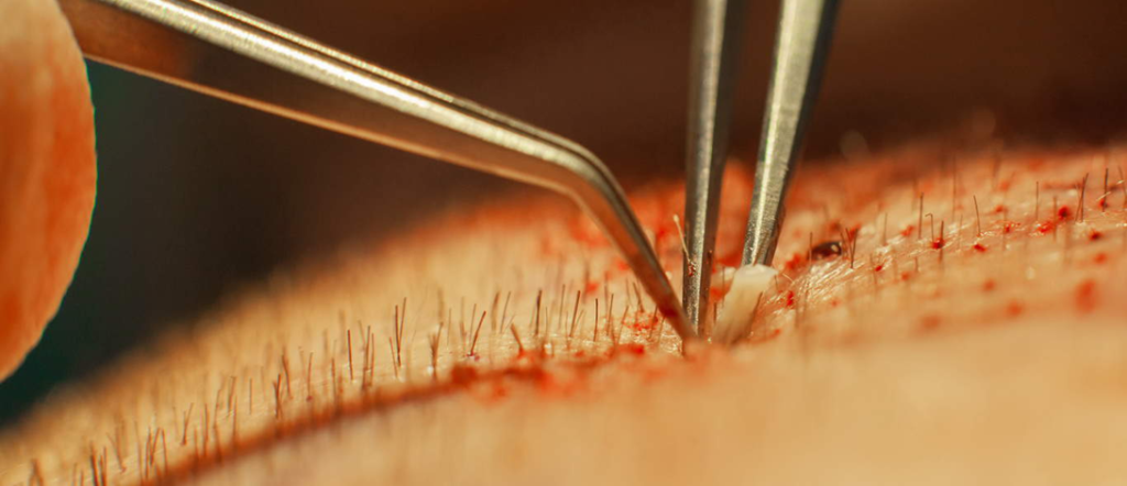 Νεκρός 38χρονος Βρετανός μετά από μεταμόσχευση μαλλιών στην Τουρκία