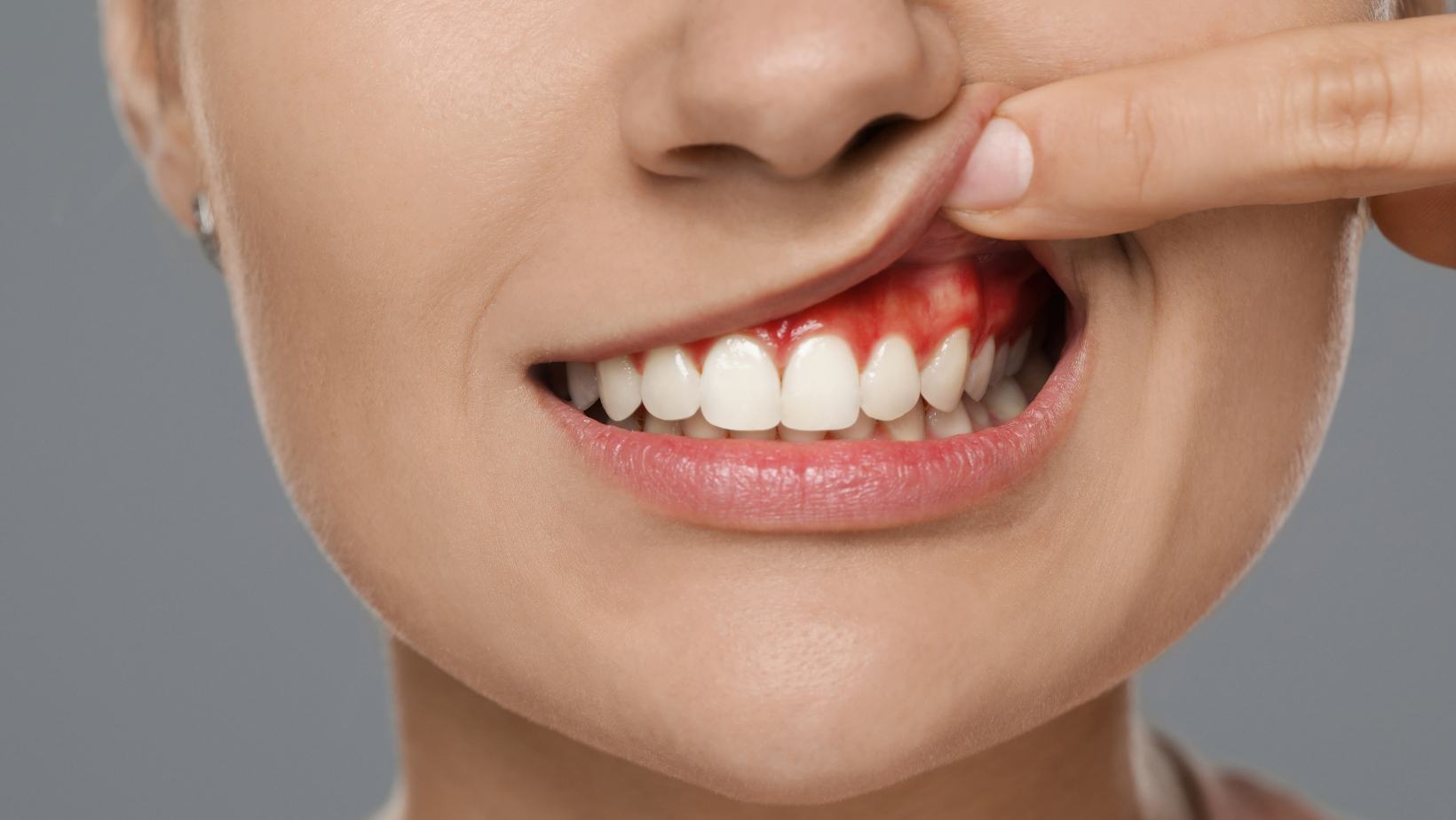 Αυτές είναι οι 12 αιτίες που υποχωρούν τα ούλα – Όσα πρέπει να ξέρετε