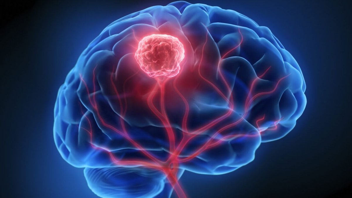 Όγκος στο κεφάλι: Αυτά είναι τα ένοχα συμπτώματα που δεν πρέπει ποτέ να αγνοήσετε