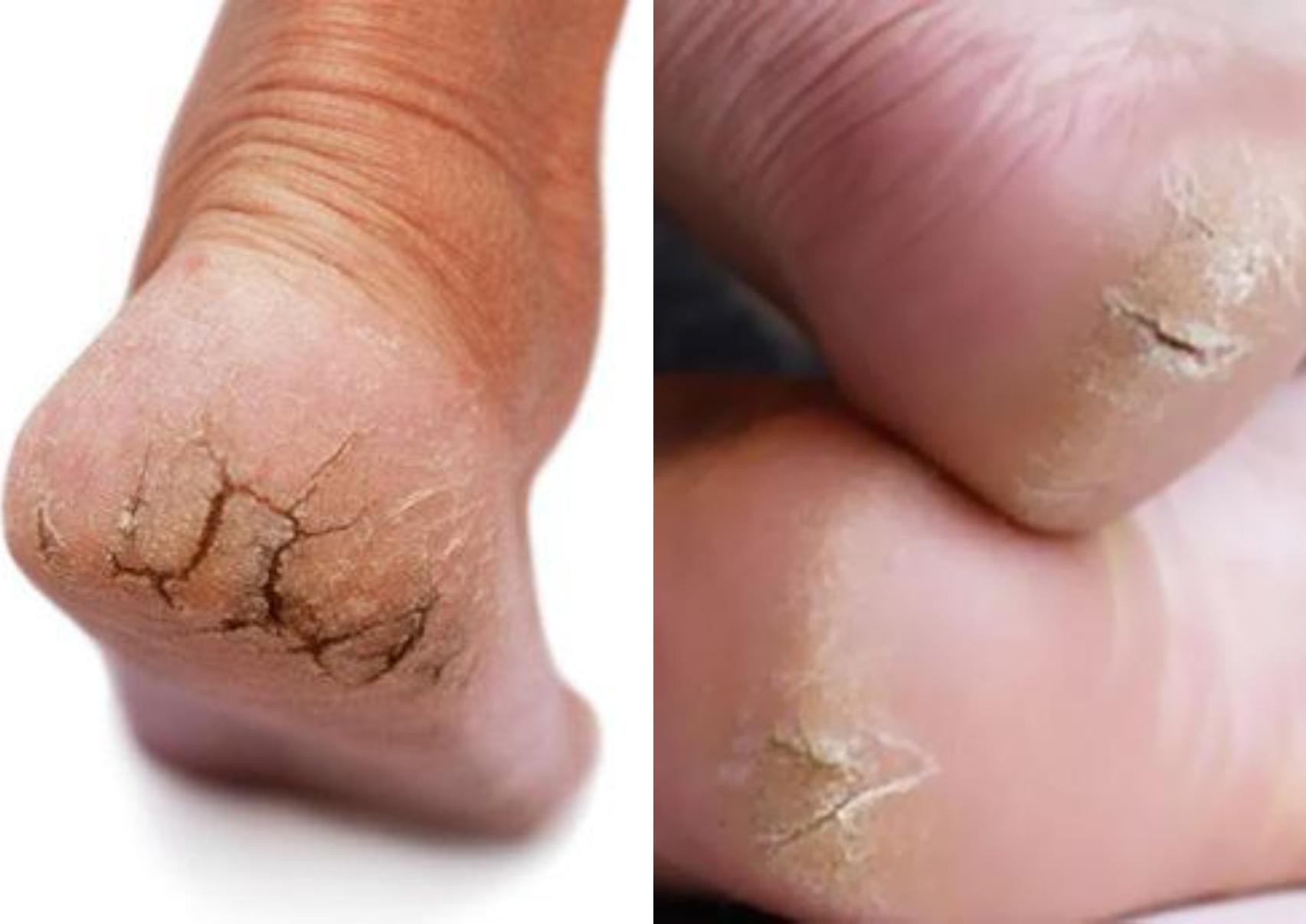 Τι σημαίνουν οι ρωγμές στις φτέρνες – Πότε δεν πρέπει να τις αγνοήσετε