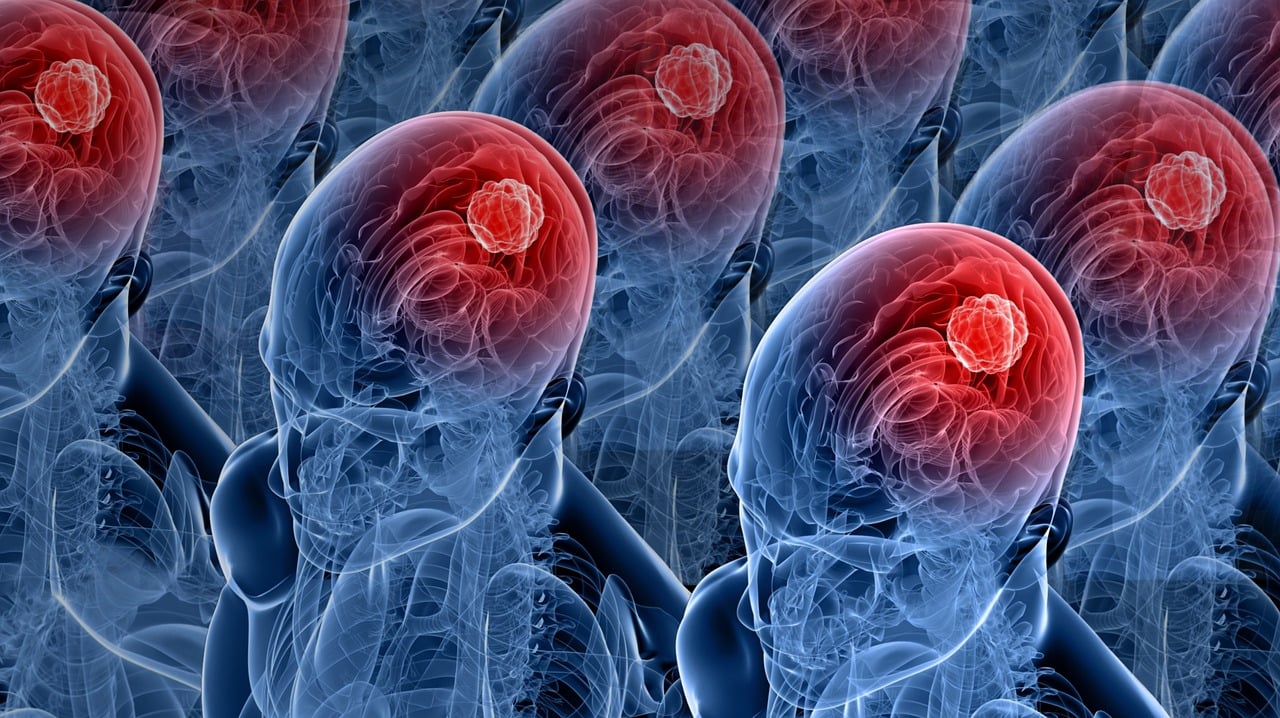 Ο FDA ενέκρινε το πρώτο φάρμακο για σπάνιο, επιθετικό καρκίνο του εγκεφάλου