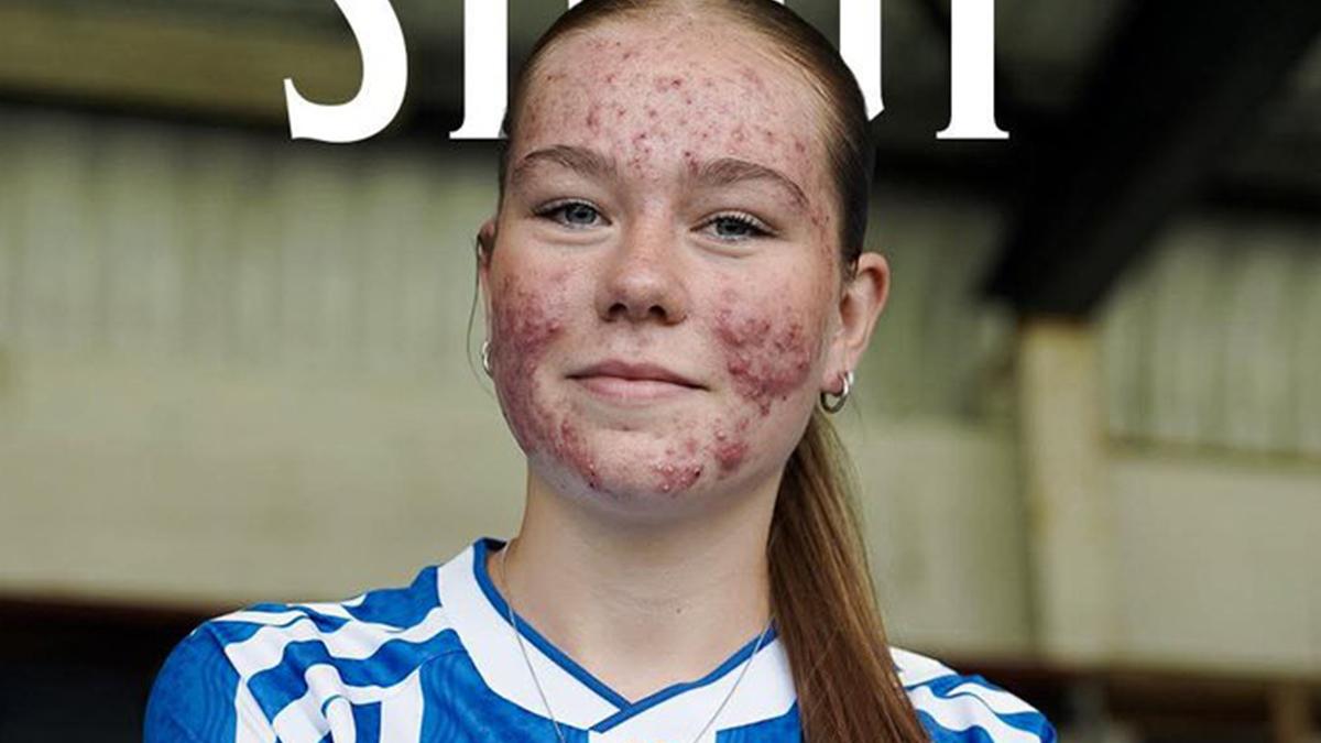 Σκάι Στάουτ: Η 16χρονη παίκτρια της Κιλμάρνοκ έπεσε θύμα διαδικτυακού bullying εξαιτίας της ακμής στο πρόσωπό της