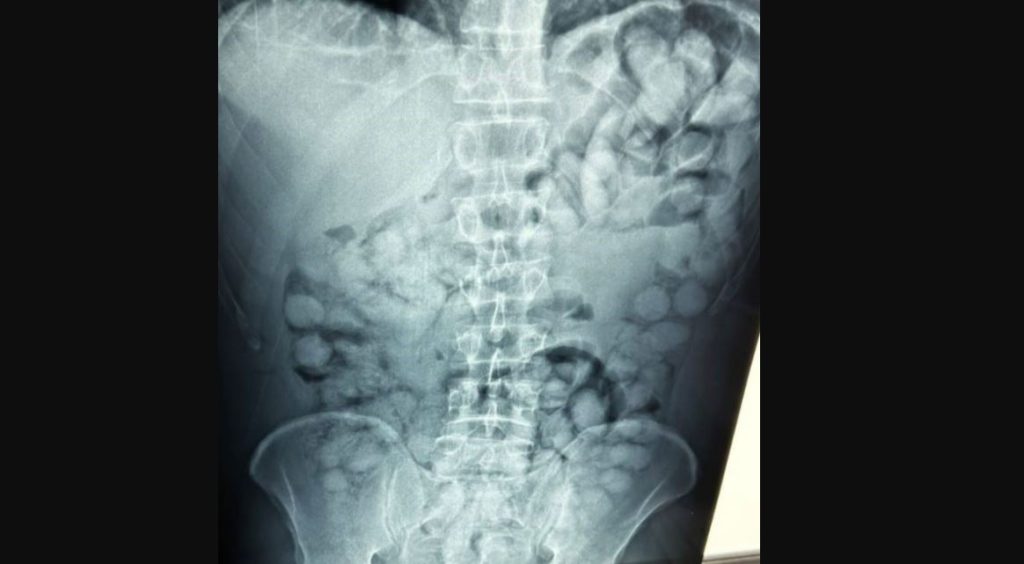 Βραζιλιάνος συνελήφθη στο «Ελ.Βενιζέλος» – Ακτινογραφία έδειξε πως είχε καταπιεί 100 συσκευασίες κοκαΐνης! (φωτο)