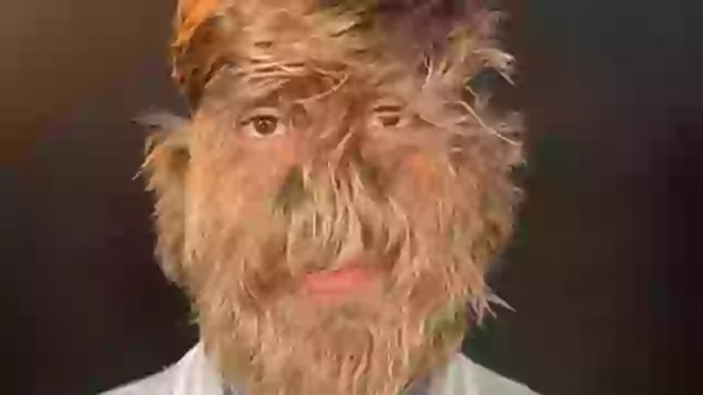 Υπερτρίχωση: Το σύνδρομο του λυκανθρώπου