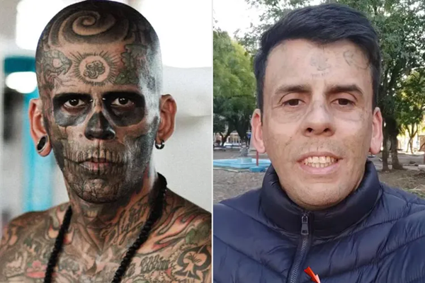 Βραζιλία: Άνδρας με 170 τατουάζ τα αφαίρεσε μετά από πέντε επίπονες χειρουργικές επεμβάσεις (βίντεο)