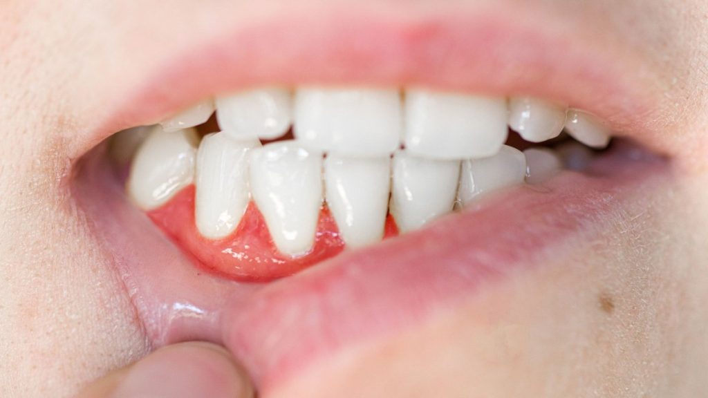 Ιαπωνία: Αναπτύχθηκε φάρμακο που επιτρέπει την φυσική αναγέννηση δοντιών