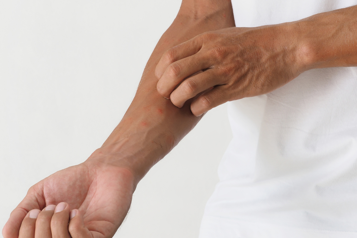 Τι προκαλεί τα κόκκινα εξογκώματα στο δέρμα; – Οι συνήθεις αιτίες