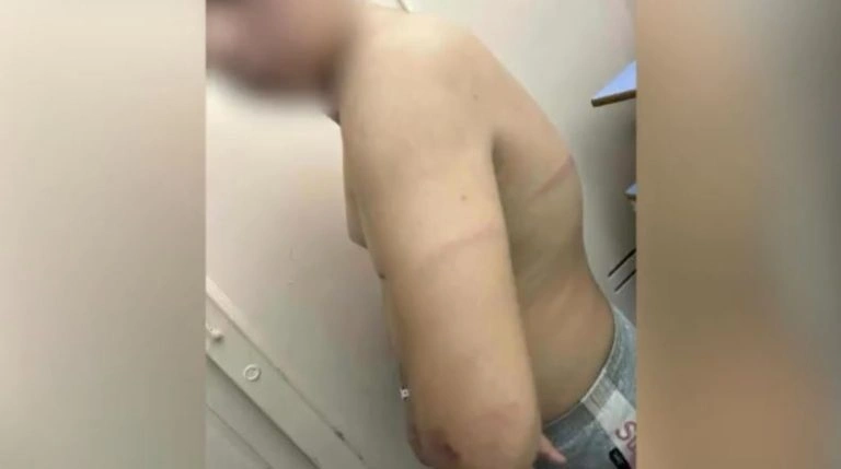 Ξυλοδαρμός 13χρονου στη Θεσσαλονίκη: «Λείπει κομμάτι από το κεφάλι του» λέει ο πατέρας του 