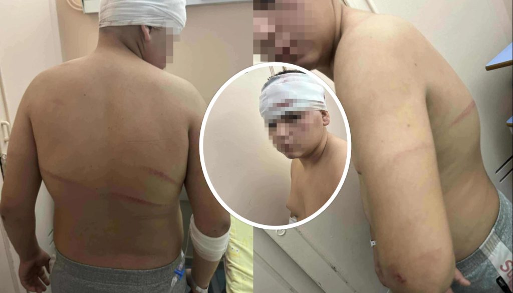 Πατέρας 13χρονου που ξυλοκοπήθηκε στη Θεσ/νίκη: «Τον χτυπούσαν με μπετόβεργες – Έχει τρύπες 15 πόντους στο κεφάλι»