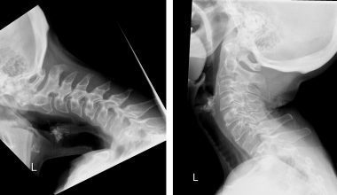 Το… σύνδρομο της σκυφτής ζωής: Τα προβλήματα που προκύπτουν εξαιτίας του κινητού μας