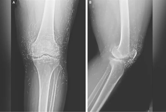 Ν.Κορέα: Γιατροί βρήκαν νήματα από καθαρό χρυσό στα γόνατα 65χρονης γυναίκας