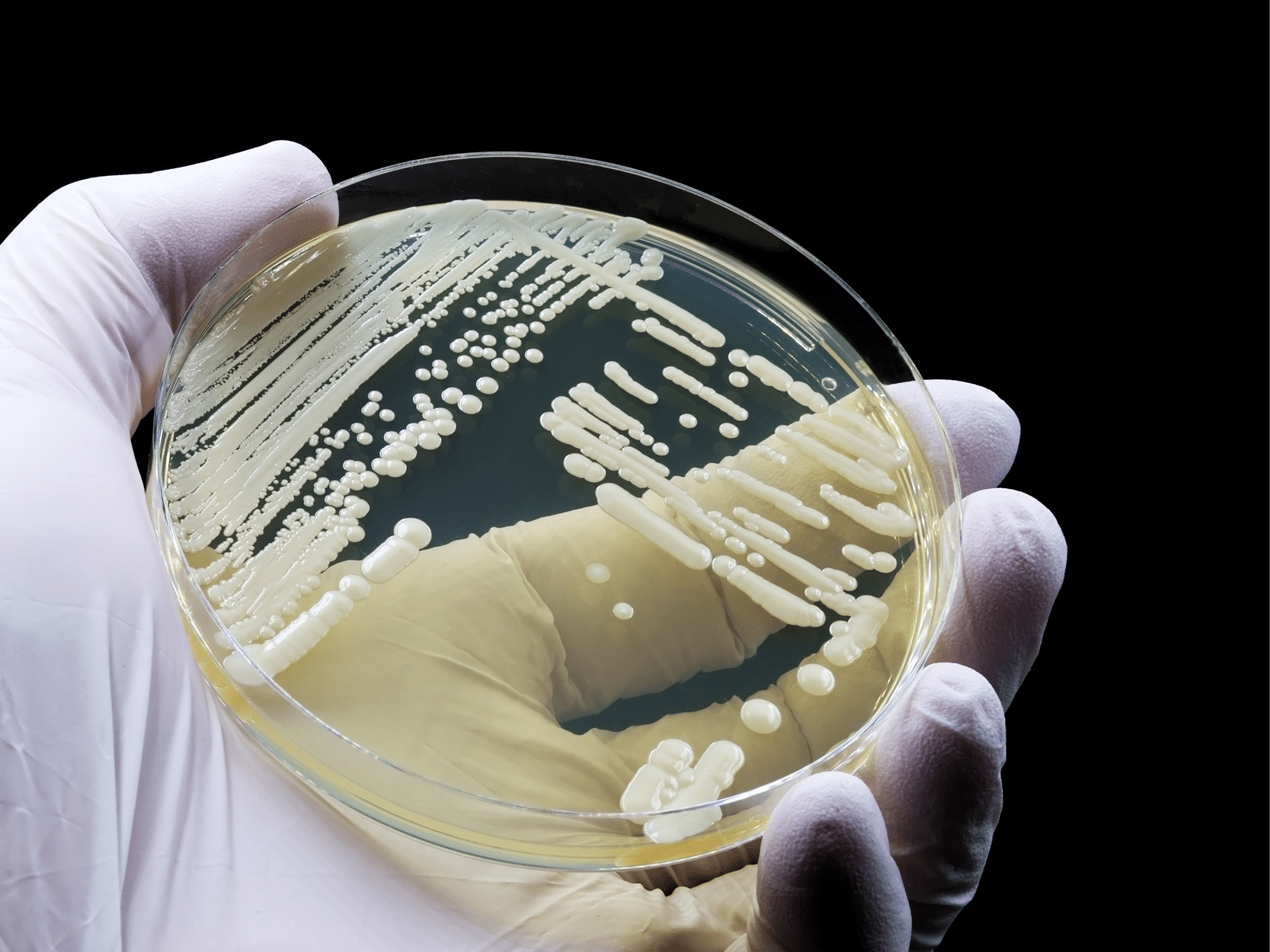 Candida auris: 2η στην Ευρώπη η Ελλάδα σε αριθμό κρουσμάτων