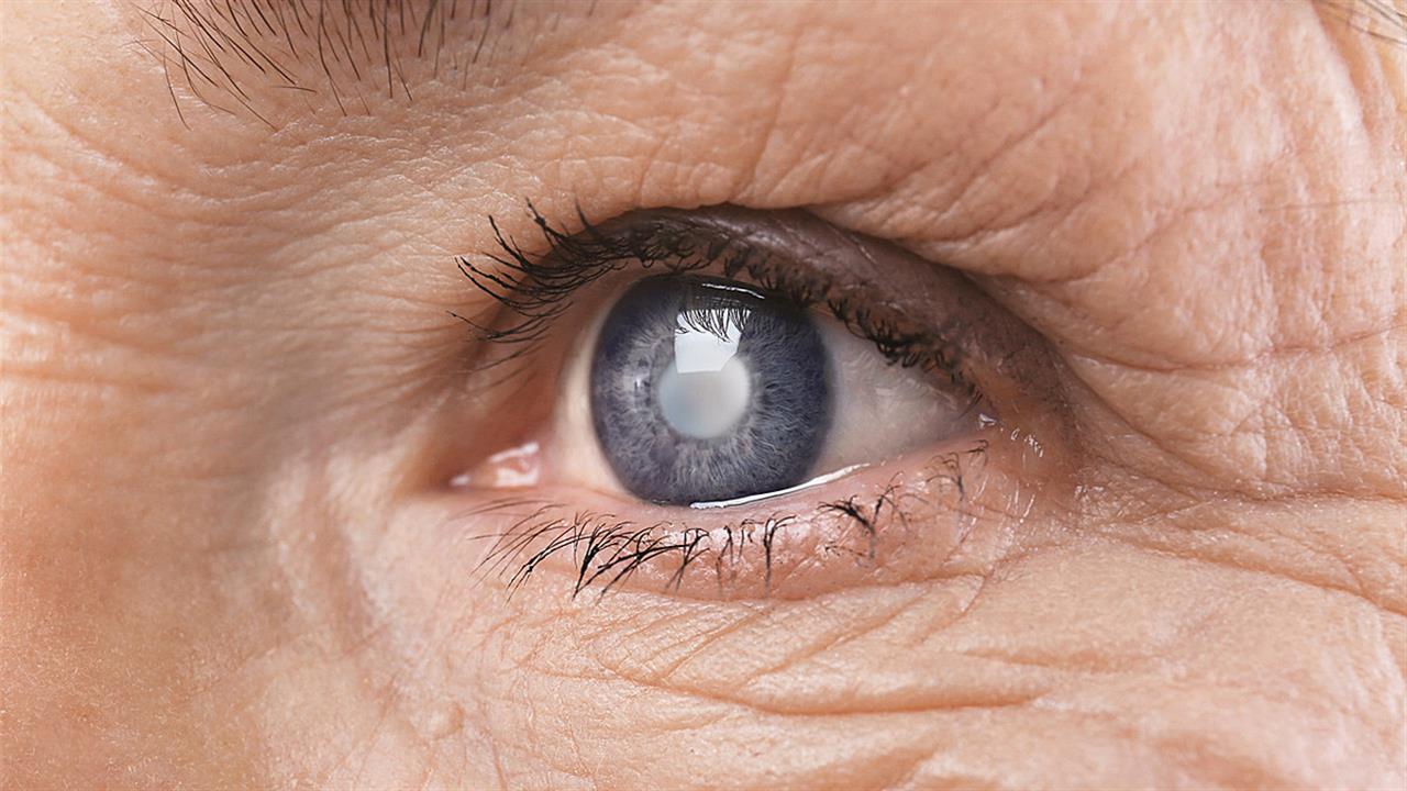 Η επέμβαση καταρράκτη και στα δύο μάτια την ίδια μέρα μπορεί να είναι ασφαλής και αποτελεσματική