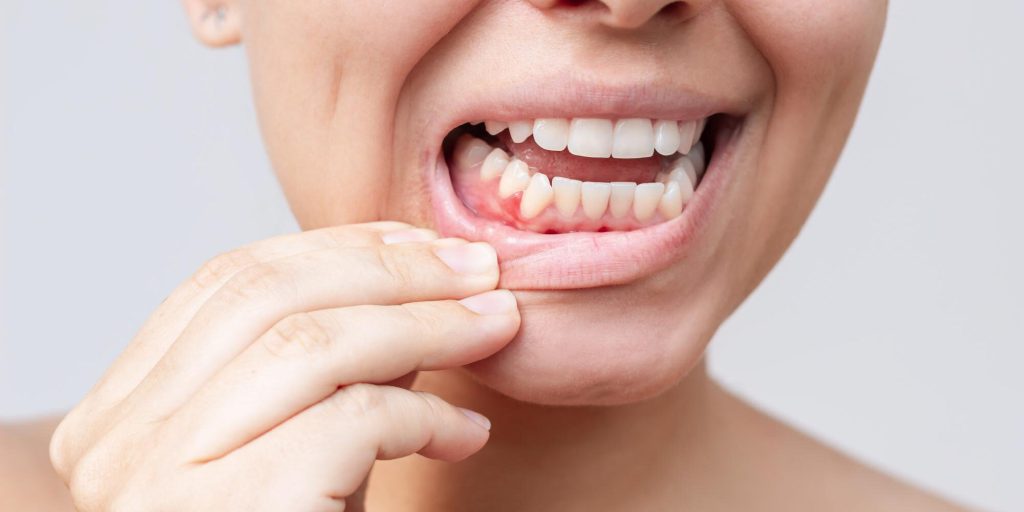 Η μεσογειακή διατροφή μπορεί να μειώσει την ουλίτιδα και την φλεγμονή – Τι έδειξε έρευνα