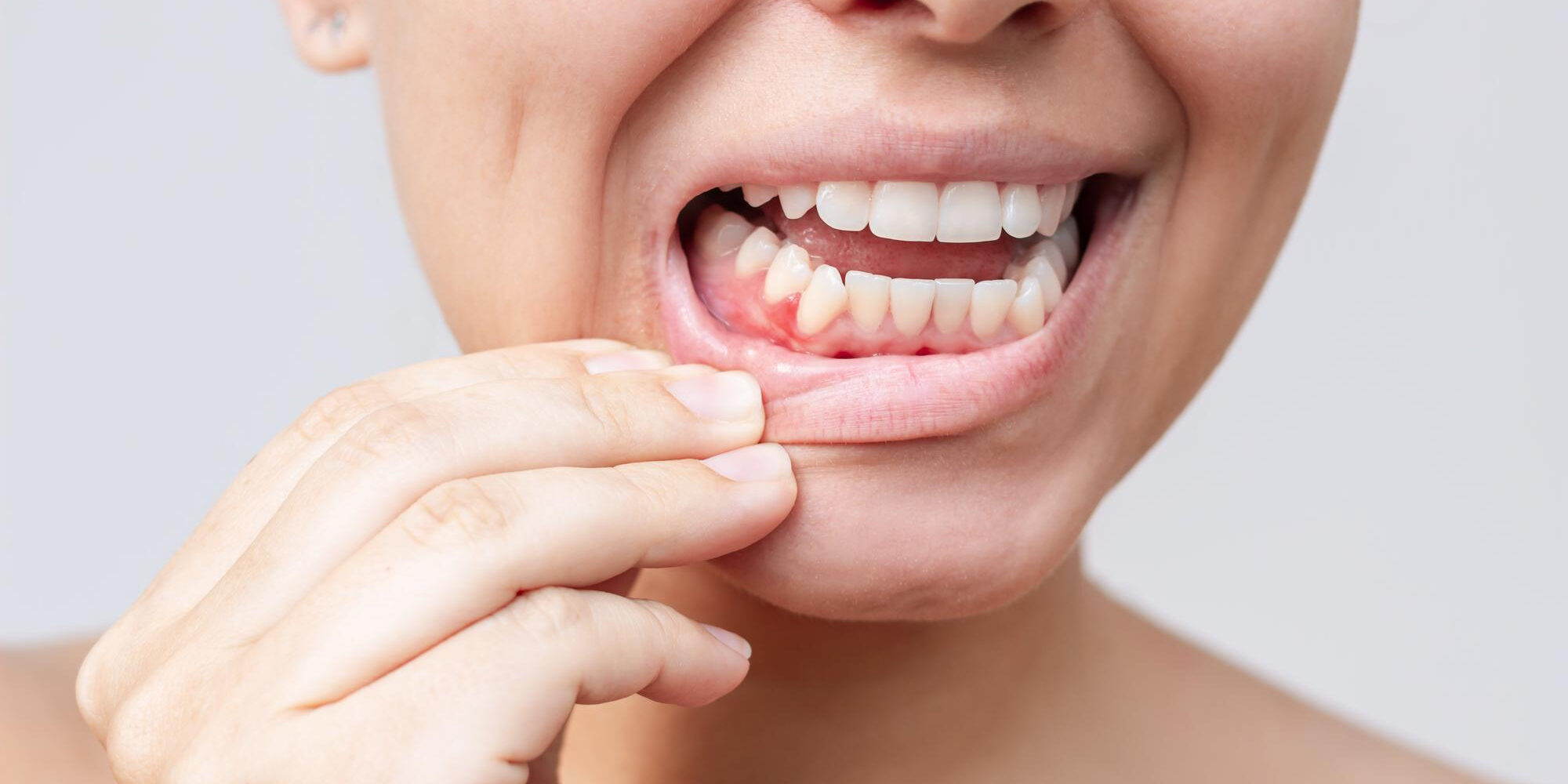 Η μεσογειακή διατροφή μπορεί να μειώσει την ουλίτιδα και την φλεγμονή – Τι έδειξε έρευνα