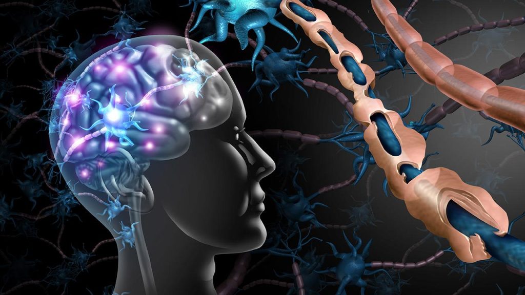 Όσα πρέπει να γνωρίζετε για την πολλαπλή σκλήρυνση – Ποια τα οκτώ πρώιμα σημάδια