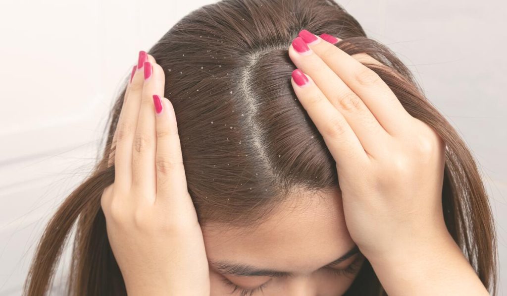 Πιτυρίδα: Τι είναι και ποιοι τρόποι αντιμετώπισης υπάρχουν