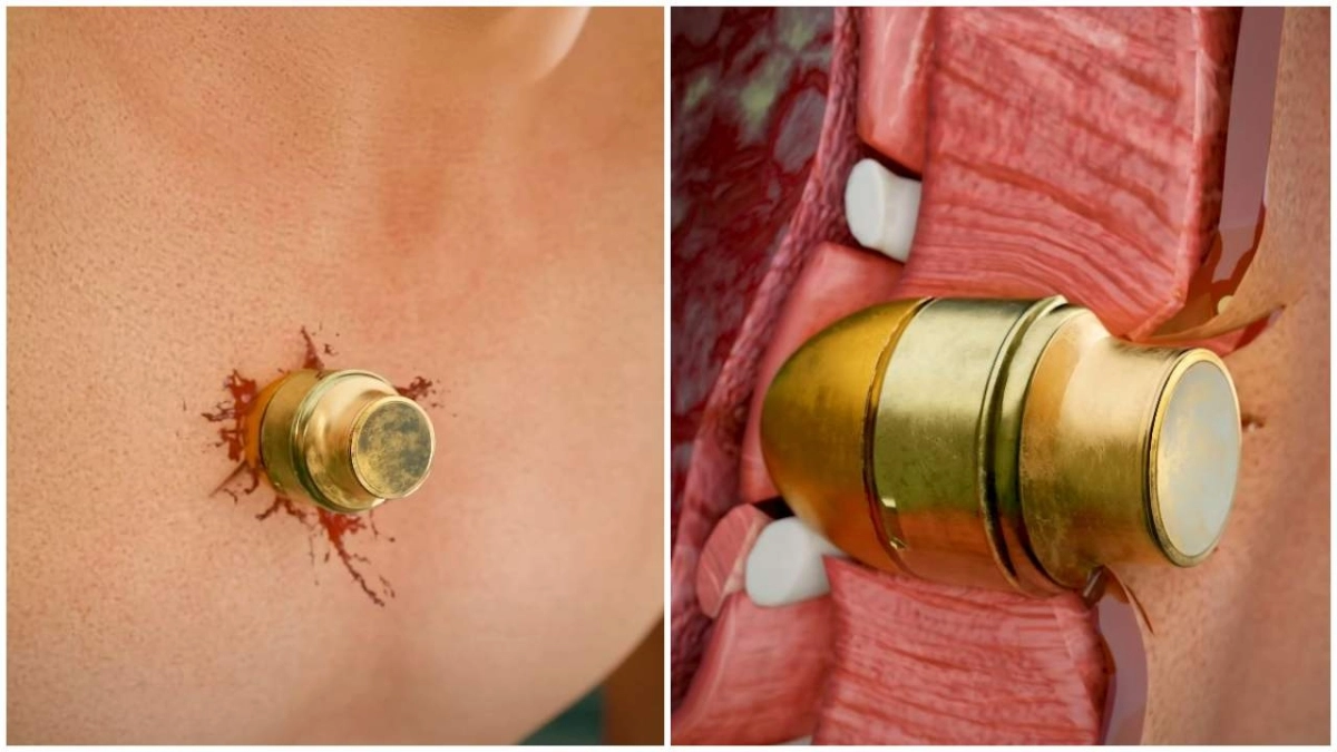 Ο Ρώσος στρατιώτης που δέχθηκε βομβίδα στο σώμα του και επέζησε (βίντεο)