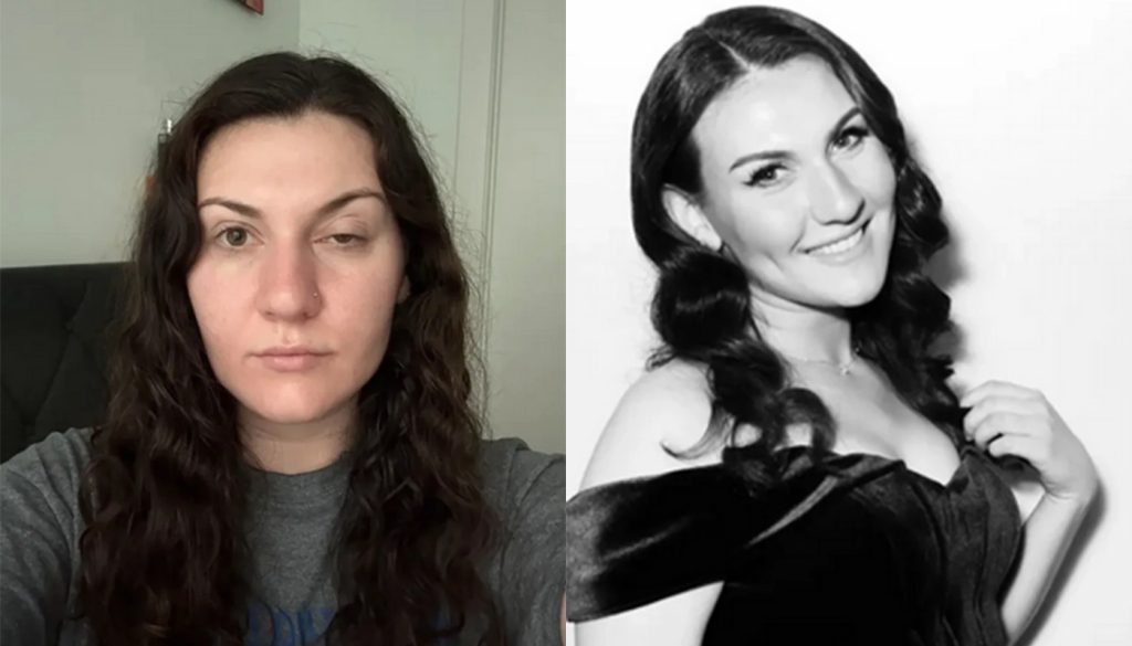 ΗΠΑ: 28χρονη δεν μπορεί να ανοίξει το μάτι της μετά από μπότοξ για την ημικρανία – Με τι διαγνώστηκε