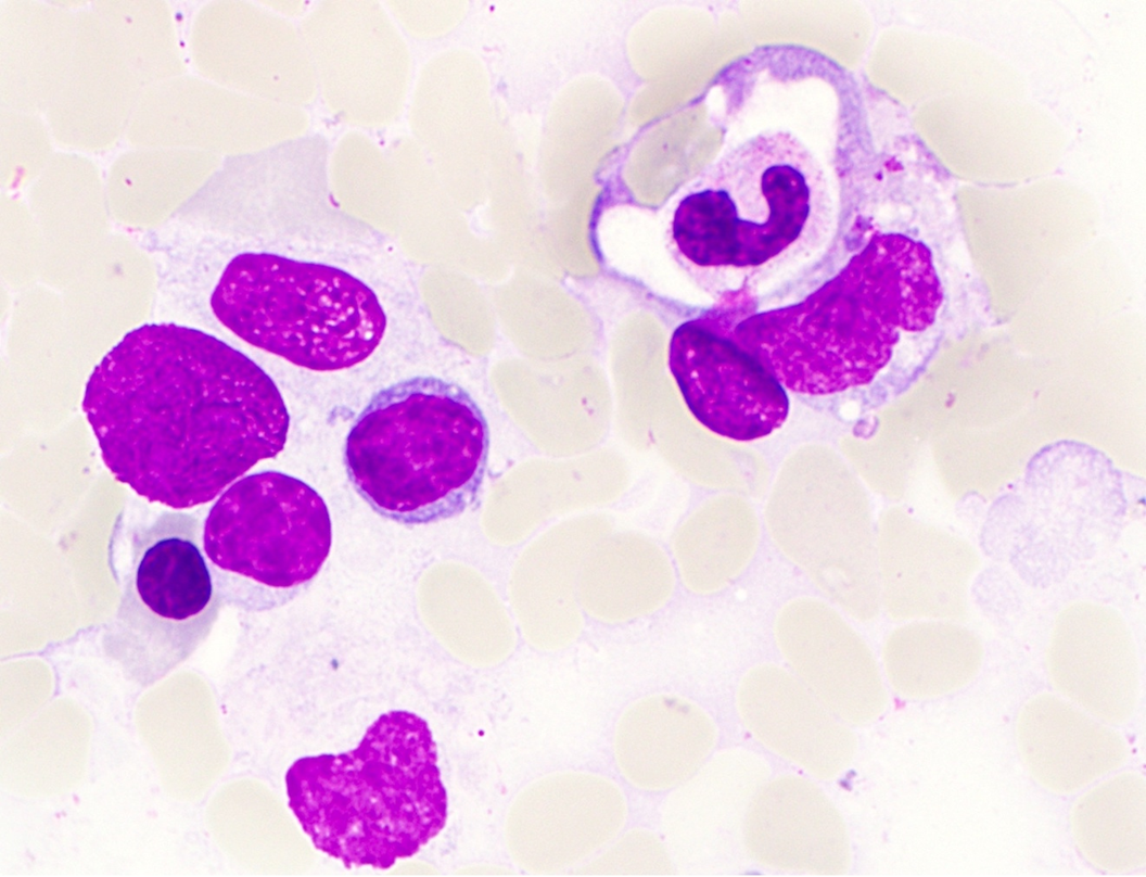 Τι είναι η αιμοφαγοκυτταρική λεμφοϊστιοκυττάρωση από την οποία έπασχε η Μαρίσσα Λαιμού; – Τα συμπτώματα