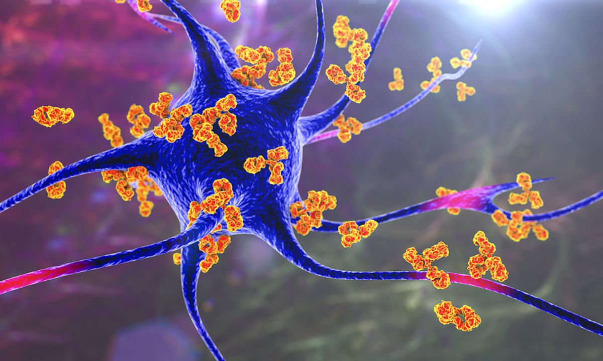 Η αυξημένη κατανάλωση υπερεπεξεργασμένων τροφίμων μπορεί να επιδεινώνει την σκλήρυνση κατά πλάκας