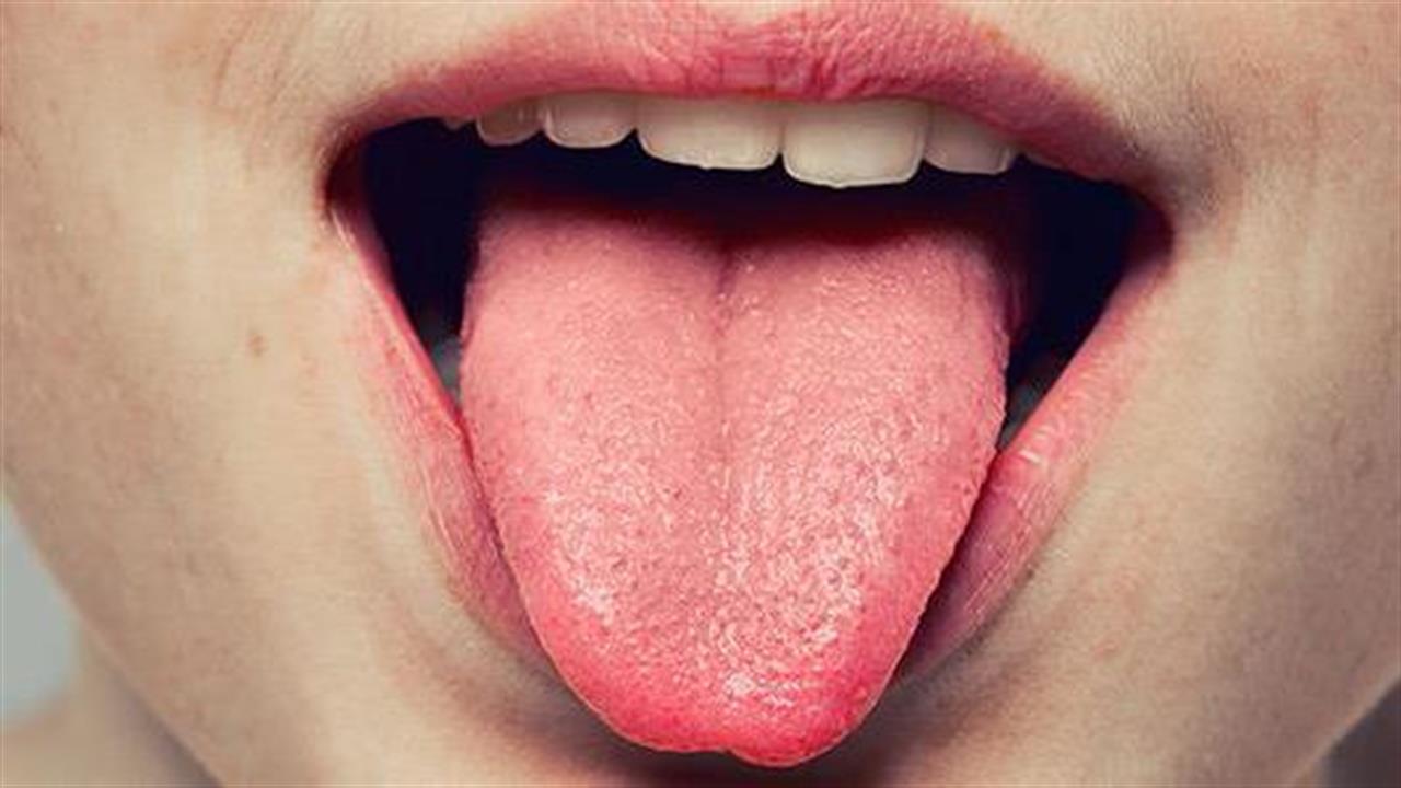 Τα σημάδια στη γλώσσα που δεν πρέπει να αγνοήσετε