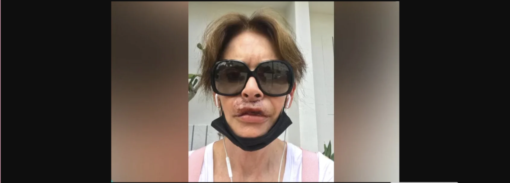 Κ.Πλουμιδάκη: Συγκλονίζει η συγγραφέας για την αποτυχημένη πλαστική στα χείλη – «Δεν μπορώ να κλάψω και να γελάσω»