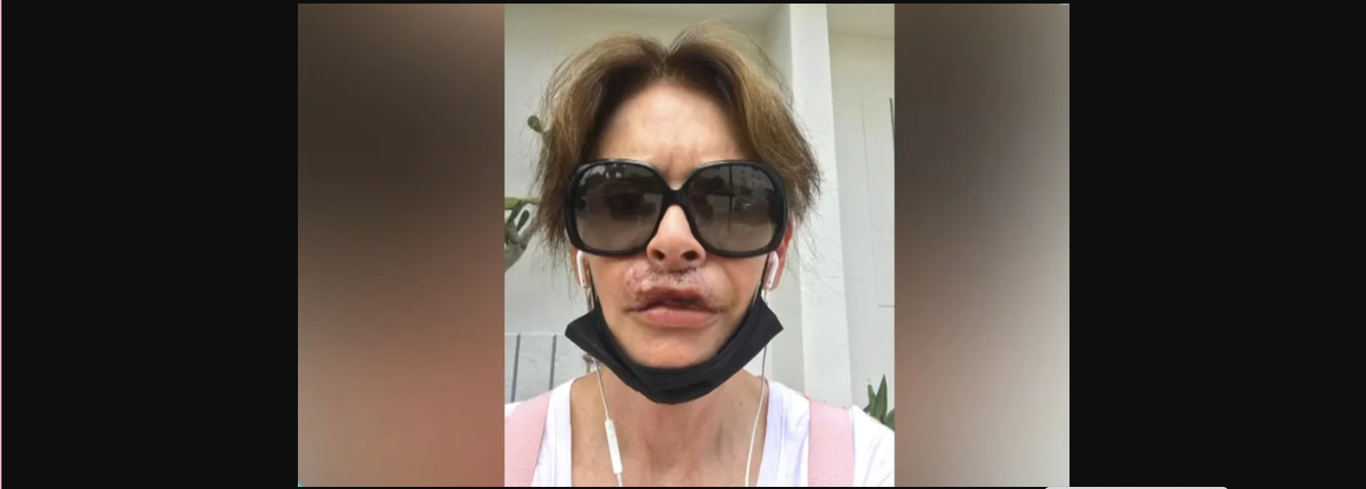 Κ.Πλουμιδάκη: Συγκλονίζει η συγγραφέας για την αποτυχημένη πλαστική στα χείλη – «Δεν μπορώ να κλάψω και να γελάσω»