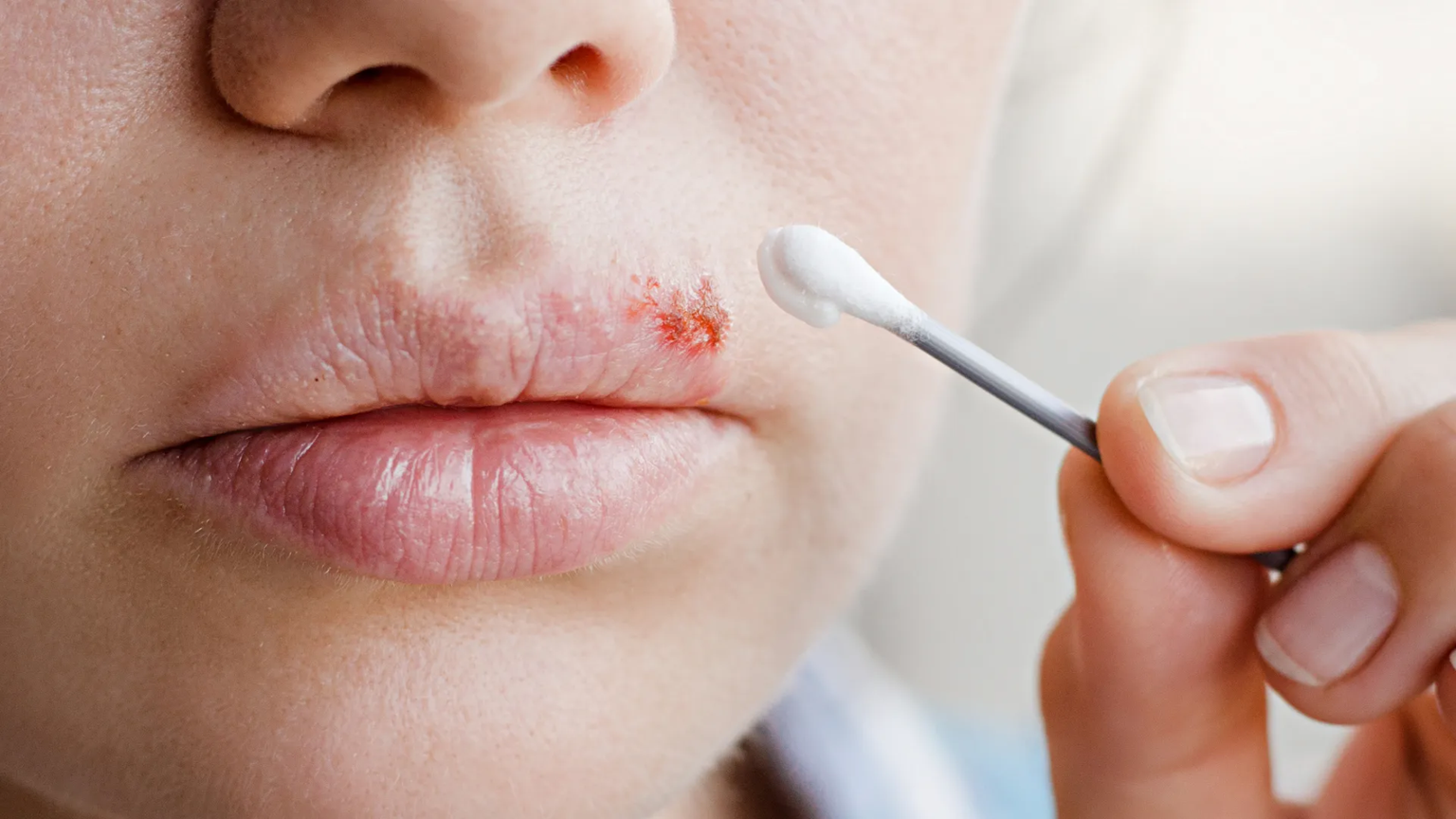 Δείτε πότε ο επιχείλιος έρπης οφείλεται σε σεξουαλική επαφή και πότε όχι – Πώς να απαλλαγείτε