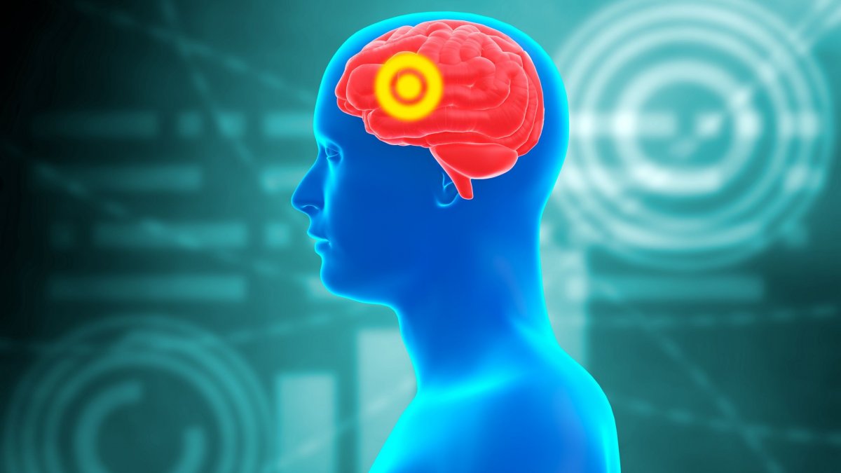 Τι είναι το ανεύρυσμα εγκεφάλου που διαγνώστηκε η Κιμ Καρντάσιαν; – Τα συμπτώματα που δεν πρέπει να αγνοήσετε