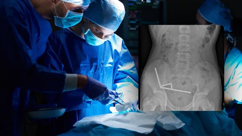 Ανήλικος στη Νέα Ζηλανδία «έφαγε» 100 μαγνήτες της TEMU – Του αφαιρέθηκαν τμήματα από το έντερό του