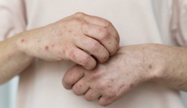 Ευλογιά των πιθήκων: Καταγράφηκε στην Ελλάδα το πρώτο κρούσμα από το επικίνδυνο στέλεχος clade 1