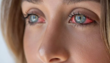 Κόκκινα μάτια: Οι πιθανές αιτίες και οι φυσικοί τρόποι αντιμετώπισης