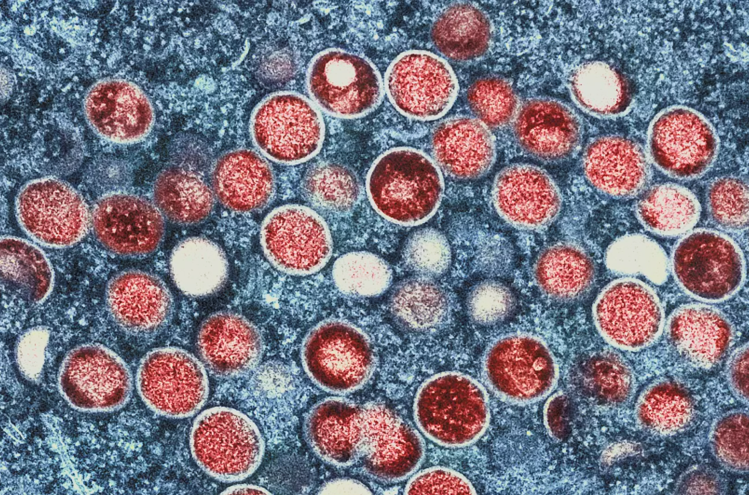 Νέο στέλεχος του ιού “mpox” εξαπλώνεται στις ΗΠΑ – Εντοπίζονται πρώτα κρούσματα τοπικής μετάδοσης