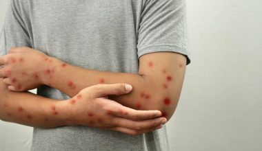 Καναδάς: Έχασε το καθεστώς εξάλειψης της ιλαράς – Σημαντική μείωση του εμβολιασμού των παιδιών