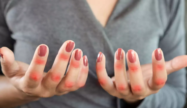 Μελέτη: Ο συστηματικός ερυθηματώδης λύκος προκαλείται από έναν συνηθισμένο ιό της παιδικής ηλικίας