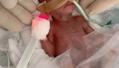 Γερμανία: Γιατροί κατάφεραν να κρατήσουν στη ζωή πρόωρο μωρό που ζύγιζε μόλις 300 γραμμάρια! – Δείτε φωτογραφίες