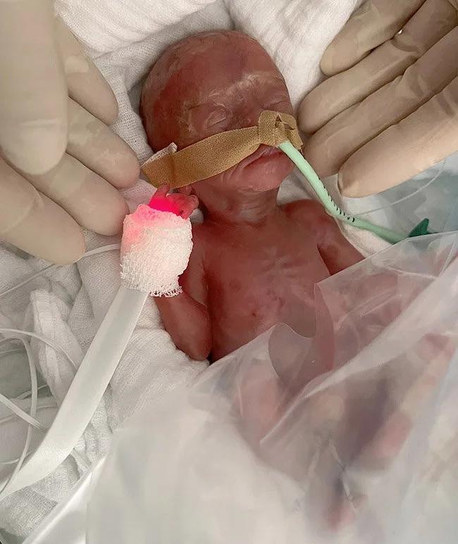 Γερμανία: Γιατροί κατάφεραν να κρατήσουν στη ζωή πρόωρο μωρό που ζύγιζε μόλις 300 γραμμάρια! – Δείτε φωτογραφίες