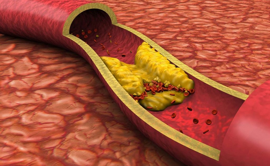 «Εnlicitide decanoate»: Το φάρμακο που μειώνει κατά σχεδόν 60% την κακή χοληστερόλη – Τι έδειξε μελέτη