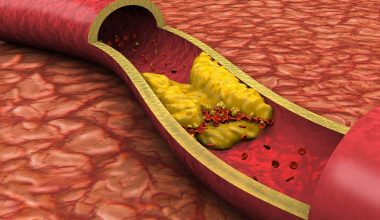 «Εnlicitide decanoate»: Το φάρμακο που μειώνει κατά σχεδόν 60% την κακή χοληστερόλη – Τι έδειξε μελέτη