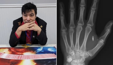 ΗΠΑ: Άνδρας στο Μιζούρι εμφύτευσε τσιπ στο χέρι του και… ξέχασε τον κωδικό! (βίντεο)