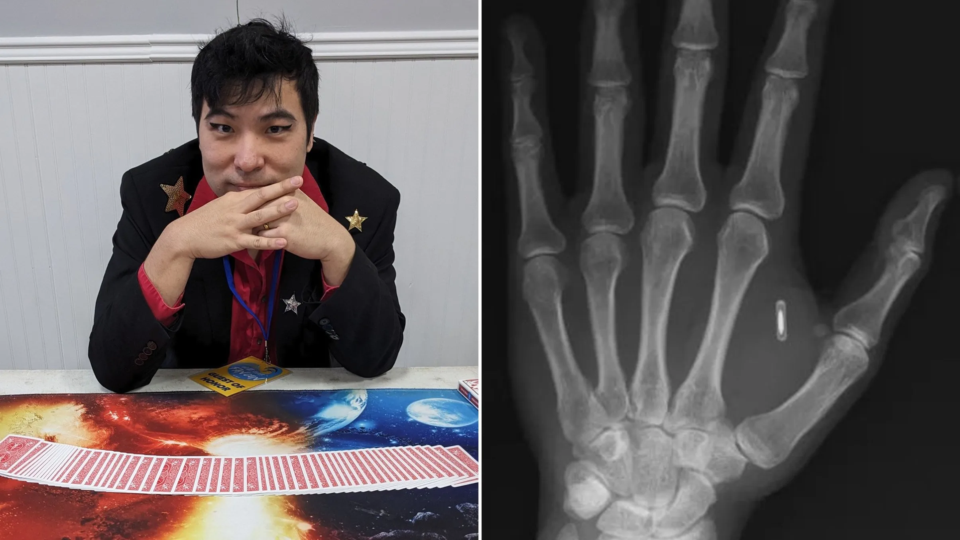 ΗΠΑ: Άνδρας στο Μιζούρι εμφύτευσε τσιπ στο χέρι του και… ξέχασε τον κωδικό! (βίντεο)